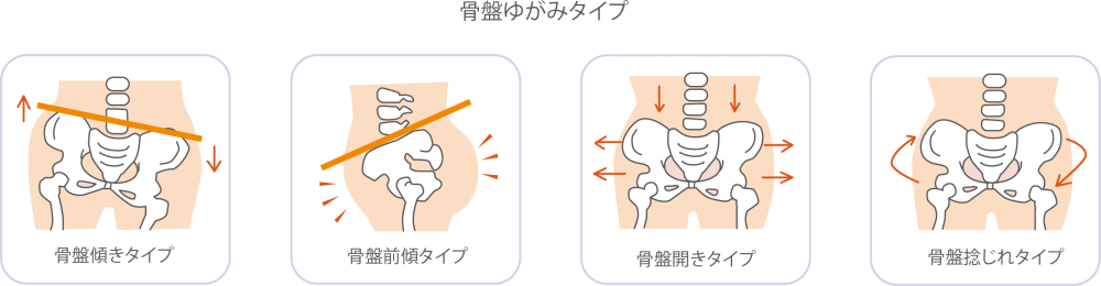 骨盤の歪みのタイプ